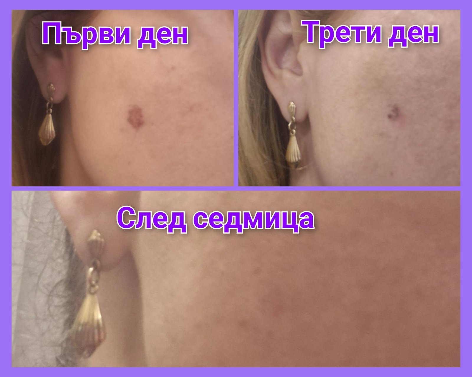Пигментно петно на бузата в първия ден, на третия ден и седмица след процедура с Lumecca IPL